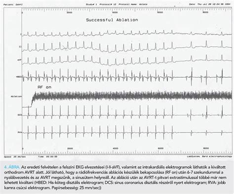 25 Years Of Follow Up Of The First Patient With Wolff Parkinson White