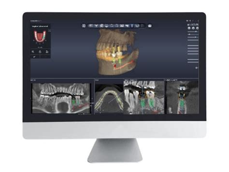 Logiciel De Planification Dentiq Guide D Industrial Imaging Co