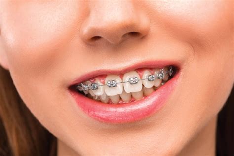 Orthodontie Enfants Centre Dentaire Empire