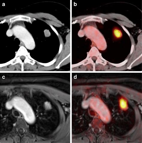 ¹⁸f Fdg Avid Pt2a Nsclc In The Left Upper Lobe Of A 59 Year Old Female Download Scientific