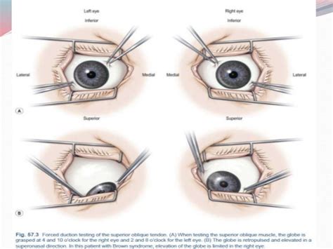 Principles of strabismus surgery