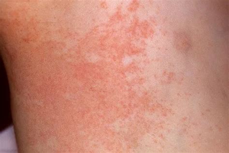 Prickly Heat What Causes Heat Rash And How To Soothe Itchy Skin With