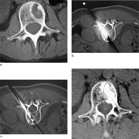 Right Iliac Metastasis From Breast Cancer A Axial Ct Image Shows A Download Scientific