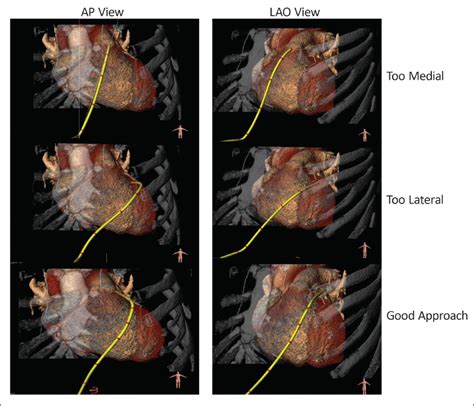 Epicardial Access For Left Atrial Appendage Occlusion Techniques And