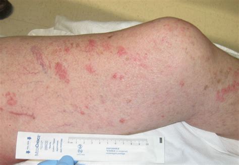 Shingles Leg Dermatome