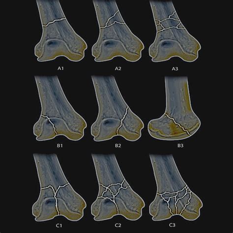 Distal Femur Fractures Statpearls Ncbi Bookshelf