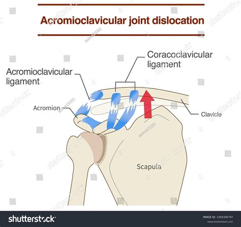 Dislocation Of The Acromioclavicular Joint And Royalty Free Stock Vector 2369396797