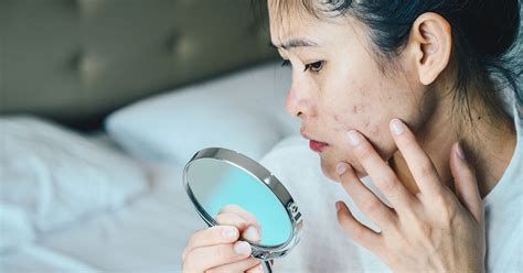 Adult Acne In Women Whats Triggering Your Breakouts