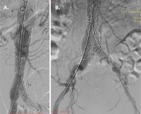 Stent Graft Implantation A Stent Graft Endurant Ii 3616145 Mm