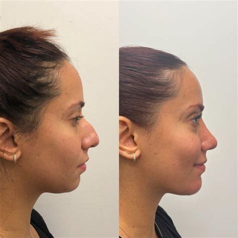 Cout Rhinoplastie Tunisie Estetika Tour