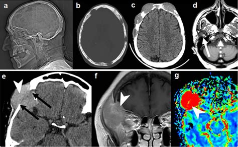 Multiple Myeloma Of The Skull Pacs