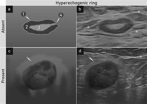 Terms Definitions And Measurements To Describe Sonographic Features Of Lymph Nodes Consensus