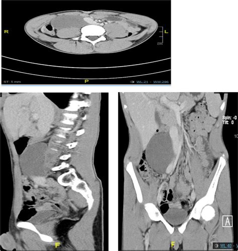 Ct Abdomen Showing A Cystic Lesion At Lower Right Retroperitoneal