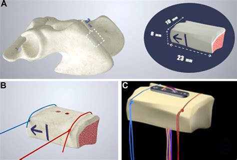 Remodeling Process And Clinical Outcomes Following All Arthroscopic Modified Eden Hybinette