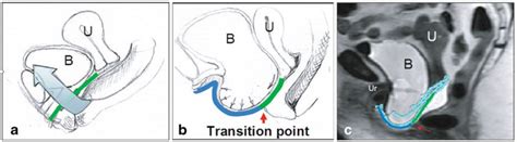 Midsagittal View Of Pelvis With Normal Support A And With Prolapse