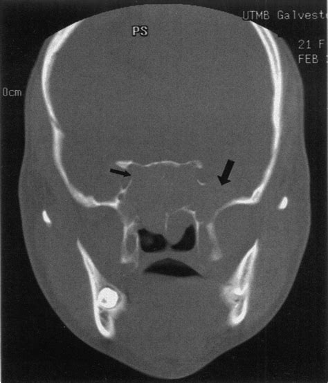 Coronal Bone Algorithm Ct Showing Extenfigure Axial Ct With Contrast