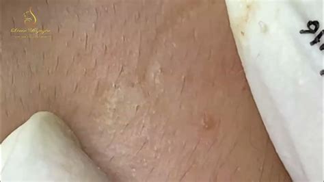 The Most Disgusting Blackhead Popping Videos Youll Ever See Youtube