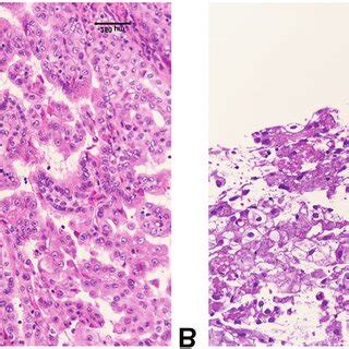 Histology Of The Biopsy A Case 1 Hematoxylin And Eosin HE Stain