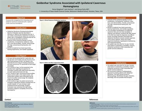 Pdf Goldenhar Syndrome Associated With A Ipsilateral Ruptured