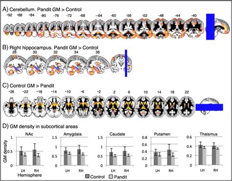 Whole Brain VBM Results In Subcortical And Cerebellar Regions Overlaid