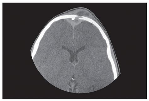 Complications of Rhinosinusitis | Ento Key