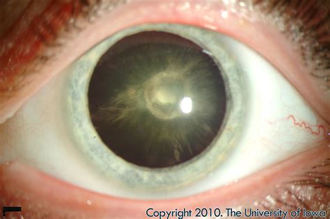 Posterior Polar Cataract Eyerounds Org Ophthalmology The