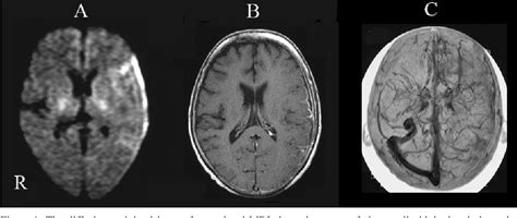 Figure 1 from A case of Streptococcus intermedius-induced subdural abscess and left transverse ...