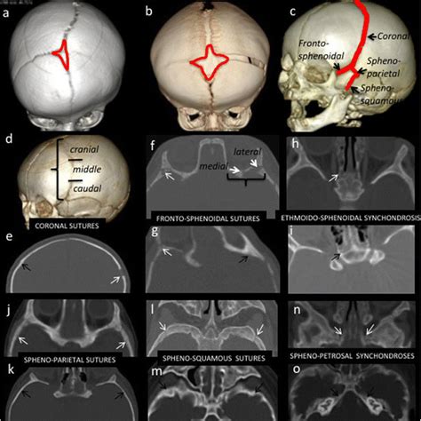 Shape Of The Anterior Fontanelle In Unicoronal Synostosis Hemicoronal