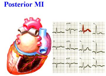 Posterior MI Recognition - emdocs