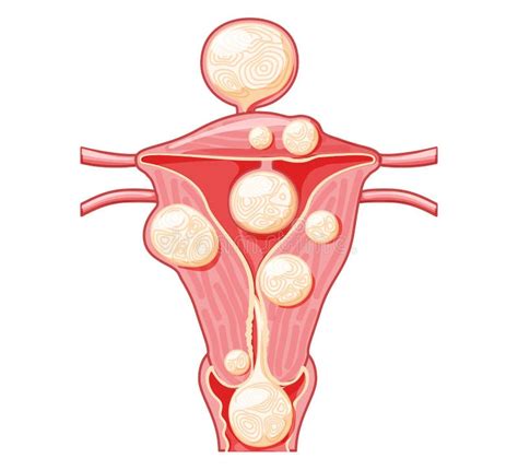 Set Of Uterine Fibroids Female Leiomyomas Reproductive System Uterus In