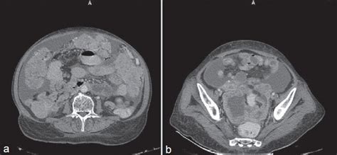 Primary Peritoneal Serous Carcinoma A Rare Case And Palliative