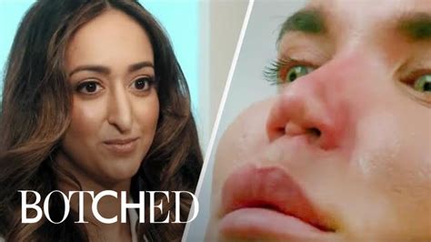 The Most Intense Nose Surgeries From Botched E YouTube