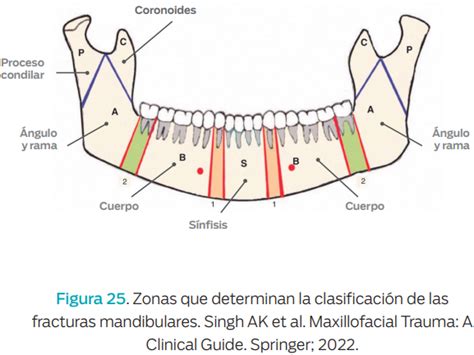 Clasificación De Fractura De Mandíbula