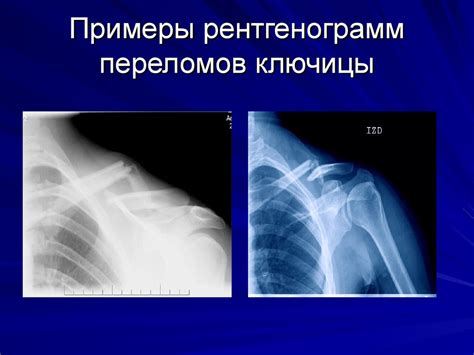Перелом ключицы со смещением и без у детей, в том числе новорождённых ...