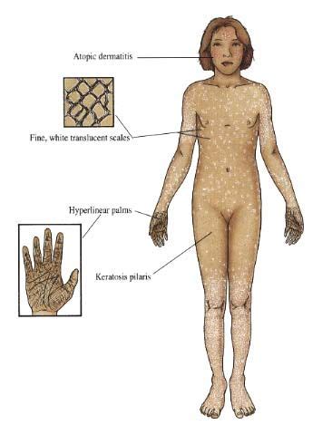 Ichthyosis Vulgaris