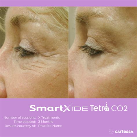 Tetra Coolpeel® And Co2 Laser Treatments Adore Aesthetix