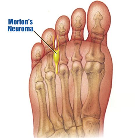 Mortons Neuroma Treatment Podiatrist Foot Doctor Charleston Sc