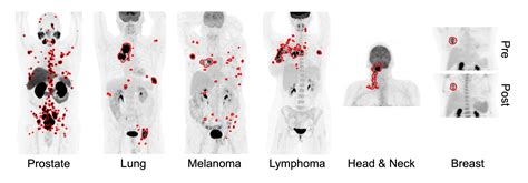 New Ai Tool Accurately Detects Six Different Cancer Types On Whole Body