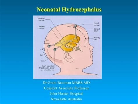 Neonatal Hydrocephalus International Hydrocephalus Imaging