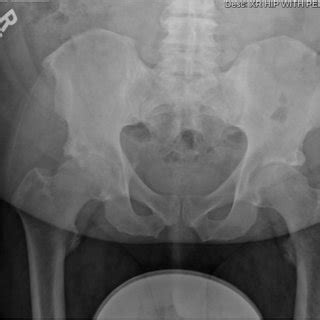 Immediate Postoperative Anteroposterior Pelvis Radiograph Following