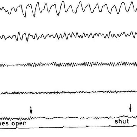 Eeg Frequency Bands A Delta Rhythm B Theta Rhythm C Alpha