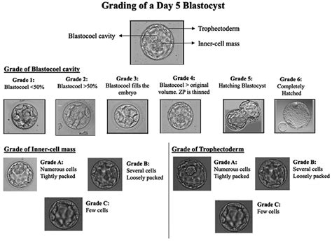 Blastocyst grading scheme of a Day 5 embryo (Blastocyst). ZP: Zona ...