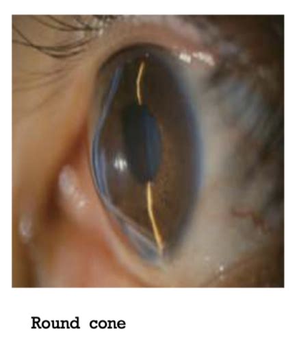 Rizzuti Sign Keratoconus