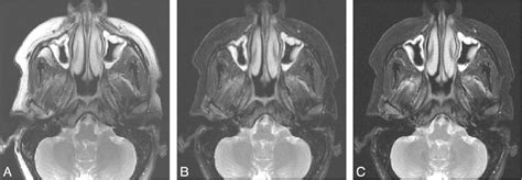 Figure 1 From Improving Fat Suppressed T2 Weighted Imaging Of The Head