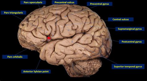 Neuroanatomy Sylvian Fissure Statpearls Ncbi Bookshelf