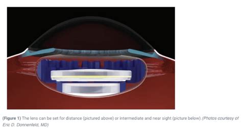 Recent Advances In Cornea And Refractive - EyeToday