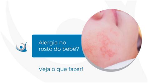 Alergia no rosto do bebê o que fazer Alergoclínica