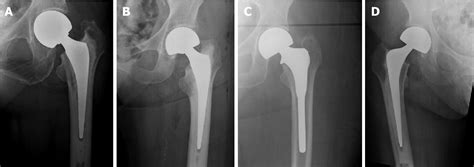 Figure 1 From Hip Hemi Arthroplasty For Neck Of Femur Fracture What Is