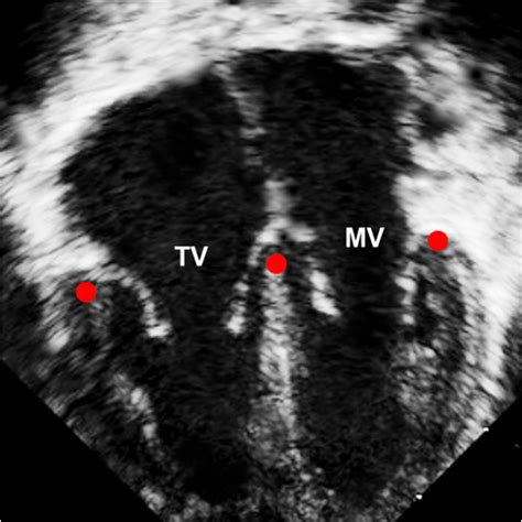 Pedi Cardiology Echo Tissue Doppler Imaging Of MV