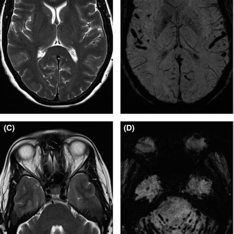 MRI spine, selected images. Sagittal T1 pre‐(A) and post‐(B) contrast ...